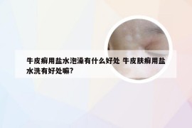 牛皮癣用盐水泡澡有什么好处 牛皮肤癣用盐水洗有好处嘛?