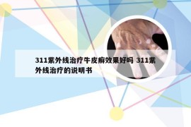 311紫外线治疗牛皮癣效果好吗 311紫外线治疗的说明书