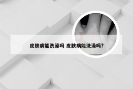 皮肤病能洗澡吗 皮肤病能洗澡吗?