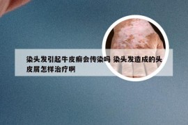 染头发引起牛皮癣会传染吗 染头发造成的头皮屑怎样治疗啊