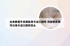 全身都是牛皮癣能用卡泊三醇吗 阴部银屑病可以用卡泊三醇软膏么