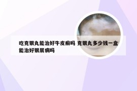 吃克银丸能治好牛皮癣吗 克银丸多少钱一盒能治好银屑病吗