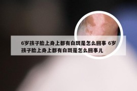 6岁孩子脸上身上都有白斑是怎么回事 6岁孩子脸上身上都有白斑是怎么回事儿