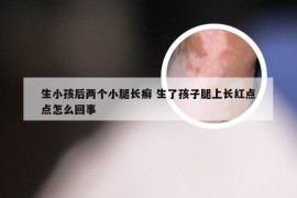 生小孩后两个小腿长癣 生了孩子腿上长红点点怎么回事