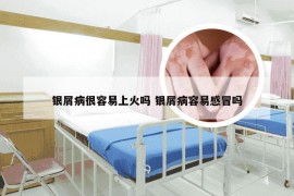 银屑病很容易上火吗 银屑病容易感冒吗