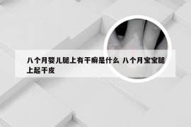 八个月婴儿腿上有干癣是什么 八个月宝宝腿上起干皮