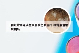 和红霉素点滴型银屑病怎么治疗 红霉素治银屑病吗