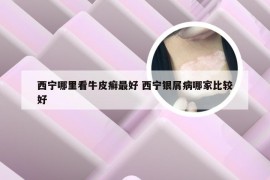 西宁哪里看牛皮癣最好 西宁银屑病哪家比较好