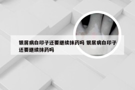 银屑病白印子还要继续抹药吗 银屑病白印子还要继续抹药吗