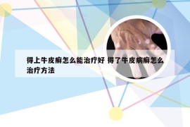 得上牛皮癣怎么能治疗好 得了牛皮病癣怎么治疗方法