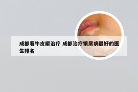 成都看牛皮廨治疗 成都治疗银屑病最好的医生排名