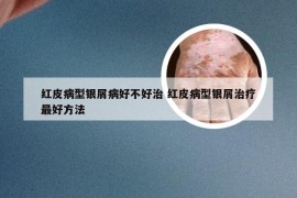 红皮病型银屑病好不好治 红皮病型银屑治疗最好方法