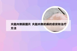 大腿内侧藓图片 大腿内侧的癣的症状和治疗方法