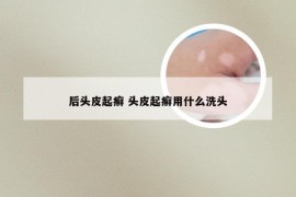 后头皮起癣 头皮起癣用什么洗头