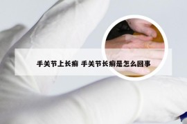 手关节上长癣 手关节长癣是怎么回事