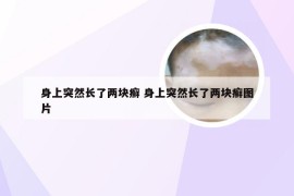 身上突然长了两块癣 身上突然长了两块癣图片