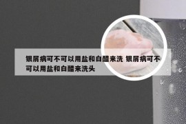 银屑病可不可以用盐和白醋来洗 银屑病可不可以用盐和白醋来洗头