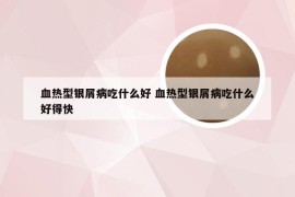 血热型银屑病吃什么好 血热型银屑病吃什么好得快