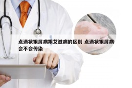 点滴状银屑病跟艾滋病的区别 点滴状银屑病会不会传染