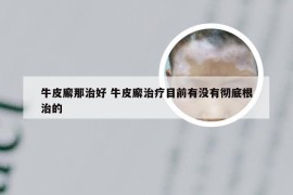 牛皮廨那治好 牛皮廨治疗目前有没有彻底根治的