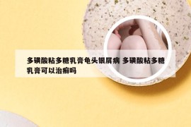 多磺酸粘多糖乳膏龟头银屑病 多磺酸粘多糖乳膏可以治癣吗