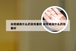 白斑病用什么药膏效果好 白斑病涂什么药效果好