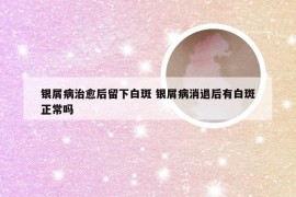 银屑病治愈后留下白斑 银屑病消退后有白斑正常吗