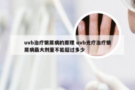 uvb治疗银屑病的原理 uvb光疗治疗银屑病最大剂量不能超过多少