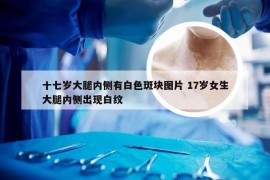 十七岁大腿内侧有白色斑块图片 17岁女生大腿内侧出现白纹