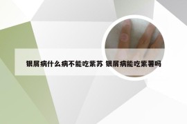 银屑病什么病不能吃紫苏 银屑病能吃紫薯吗