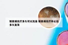 银屑病光疗多久可以洗澡 银屑病光疗停止后多久复发