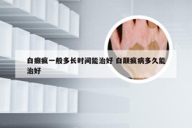 白癫疯一般多长时间能治好 白颠疯病多久能治好