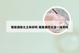 银屑病用凡士林好吗 银屑病可以涂一抹灵吗