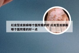 红皮型皮肤癣哪个医院看的好 红皮型皮肤癣哪个医院看的好一点