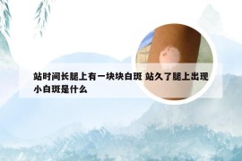 站时间长腿上有一块块白斑 站久了腿上出现小白斑是什么