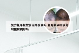 复方氟米松软膏治牛皮廨吗 复方氟米松软膏对银屑病好吗