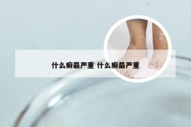 什么癣最严重 什么癣最严重