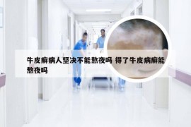 牛皮癣病人坚决不能熬夜吗 得了牛皮病癣能熬夜吗