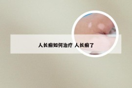 人长癣如何治疗 人长癣了