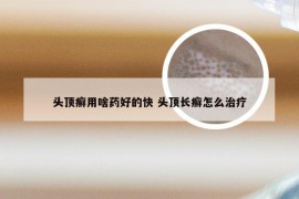 头顶癣用啥药好的快 头顶长癣怎么治疗