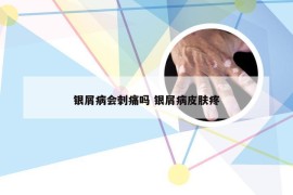 银屑病会刺痛吗 银屑病皮肤疼