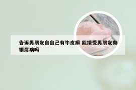 告诉男朋友自自己有牛皮癣 能接受男朋友有银屑病吗