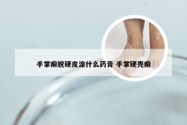 手掌癣脱硬皮涂什么药膏 手掌硬壳癣