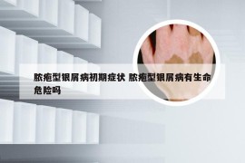 脓疱型银屑病初期症状 脓疱型银屑病有生命危险吗