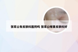 张家口有皮肤科医院吗 张家口哪里皮肤科好