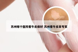 苏州哪个医院看牛皮癣好 苏州看牛皮屑专家