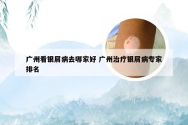 广州看银屑病去哪家好 广州治疗银屑病专家排名