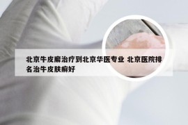 北京牛皮廨治疗到北京华医专业 北京医院排名治牛皮肤癣好