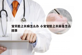 宝贝脸上长癣怎么办 小宝宝脸上长藓是怎么回事