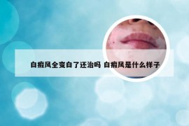 白瘕风全变白了还治吗 白瘕风是什么样子